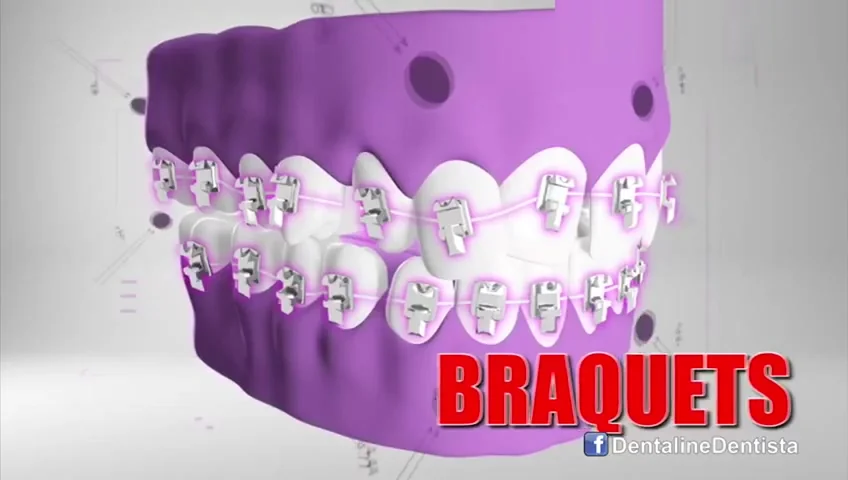 Brackets y ortodoncia — Dentaline