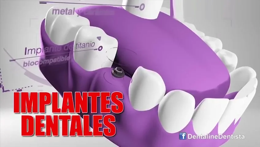 Implantes dentales — Dentaline